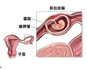 妇产科吃瓜宫外孕,妇产科里的“吃瓜”故事