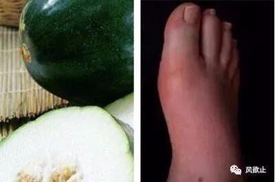 痛风是否可以吃白瓜,白瓜的食用指南