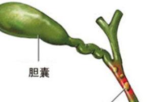 胆囊炎可以吃小乳瓜吗,胆囊炎患者可适量食用小乳瓜